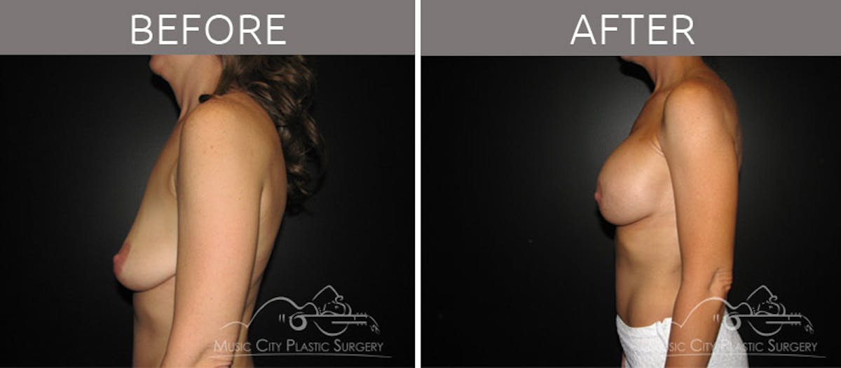 Breast Augmentation Before & After Gallery - Patient 90705149 - Image 4