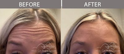 Dysport or Botox Before & After Gallery - Patient 90705144 - Image 1