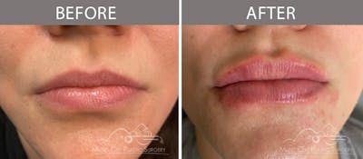 Dermal Fillers Before & After Gallery - Patient 90705142 - Image 1