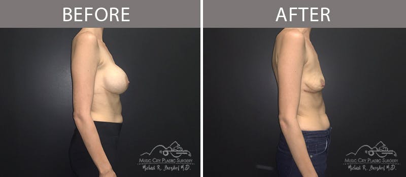 Capsulectomy Before & After Gallery - Patient 90705143 - Image 3