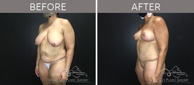 Breast Reduction with Lift Before & After Gallery - Patient 132099792 - Image 2