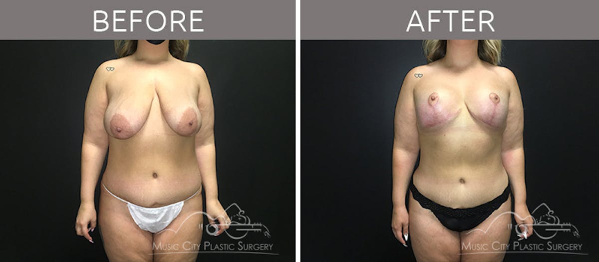 Mommy Makeover Before & After Gallery - Patient 90705147 - Image 1