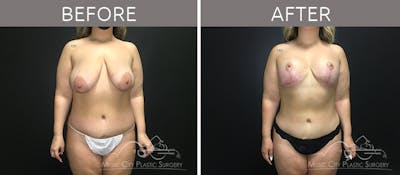 Mommy Makeover Before & After Gallery - Patient 90705147 - Image 1