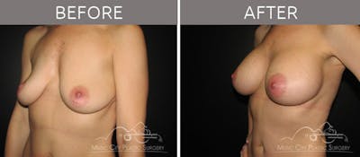 Breast Augmentation Before & After Gallery - Patient 90705149 - Image 2