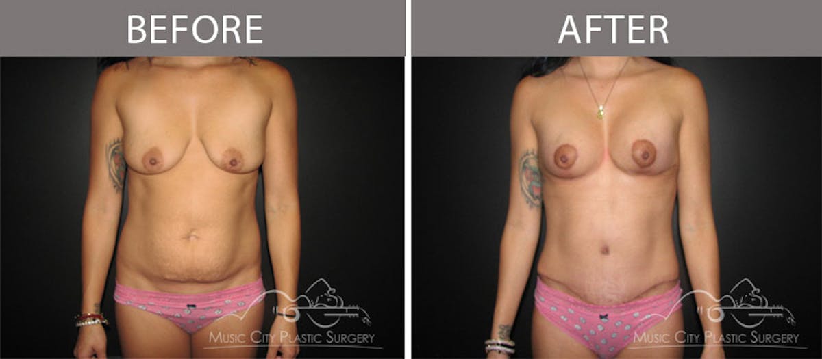Abdominoplasty Before & After Gallery - Patient 90705148 - Image 1