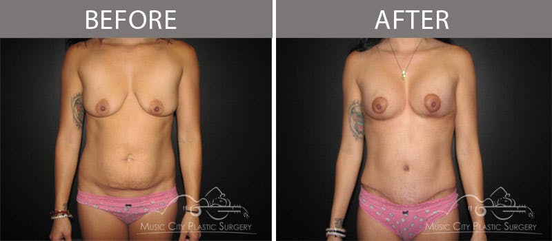 Abdominoplasty Before & After Gallery - Patient 90705148 - Image 1