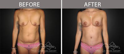 Abdominoplasty Before & After Gallery - Patient 90705148 - Image 1