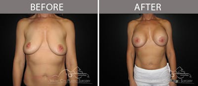 Breast Augmentation Before & After Gallery - Patient 90705149 - Image 1