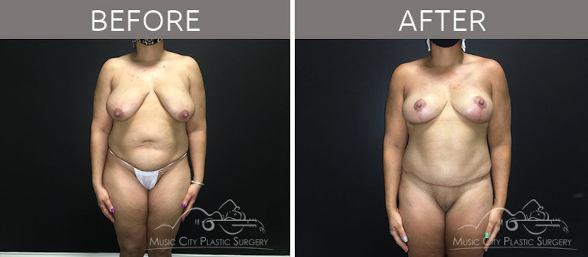 Breast Reduction with Lift Before & After Gallery - Patient 132099792 - Image 1
