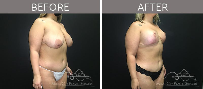 Mommy Makeover Before & After Gallery - Patient 90705147 - Image 4