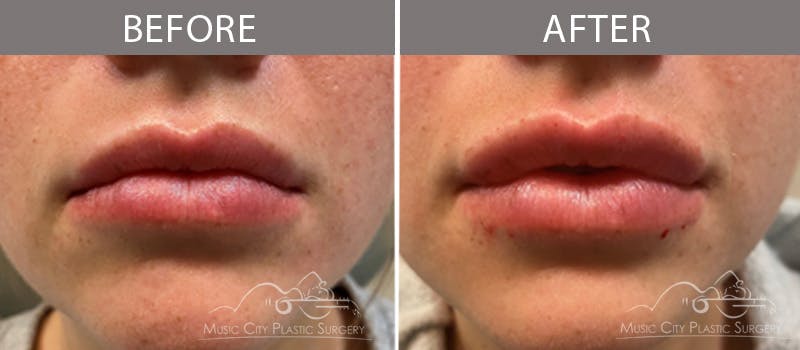 Dermal Fillers Before & After Gallery - Patient 90705146 - Image 1