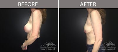 Capsulectomy Before & After Gallery - Patient 90705157 - Image 3