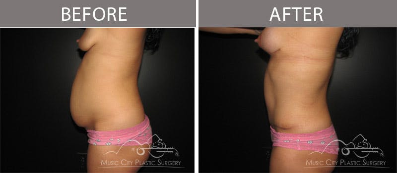 Abdominoplasty Before & After Gallery - Patient 90705148 - Image 2