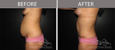 Abdominoplasty Before & After Gallery - Patient 90705148 - Image 2