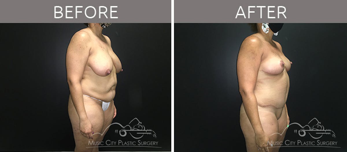 Breast Reduction with Lift Before & After Gallery - Patient 132099792 - Image 4