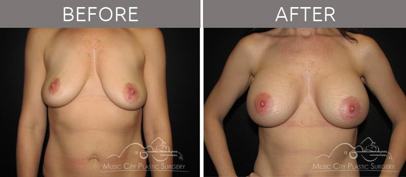 Breast Augmentation Before & After Gallery - Patient 90705149 - Image 5