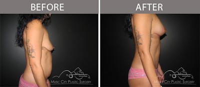 Abdominoplasty Before & After Gallery - Patient 90705148 - Image 3