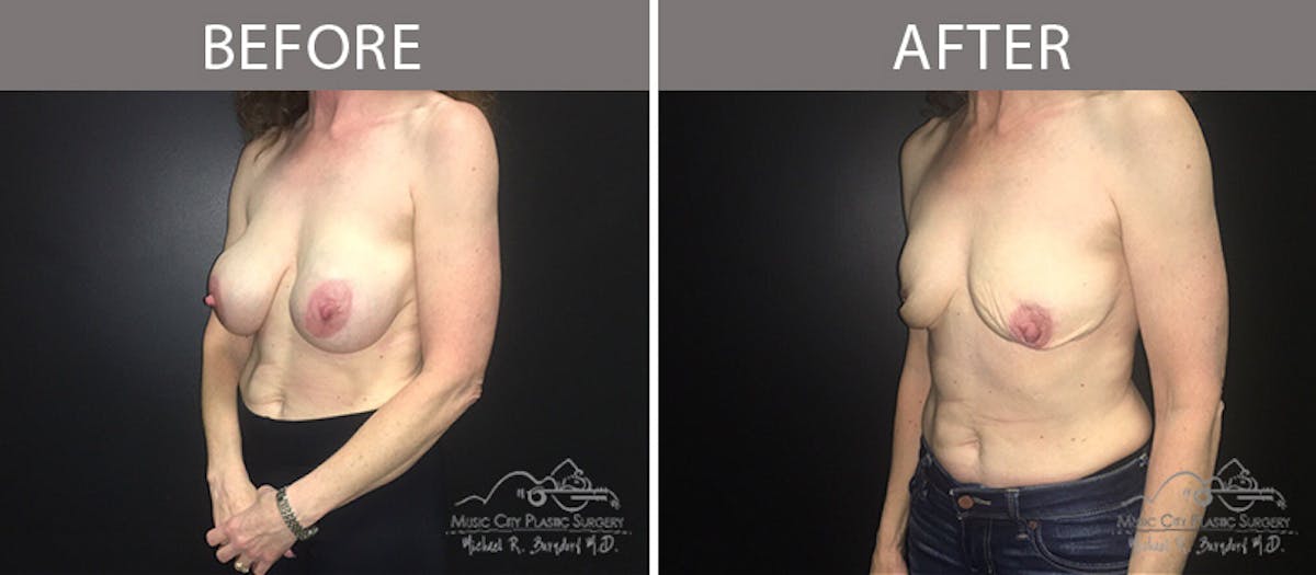 Capsulectomy Before & After Gallery - Patient 90705157 - Image 2