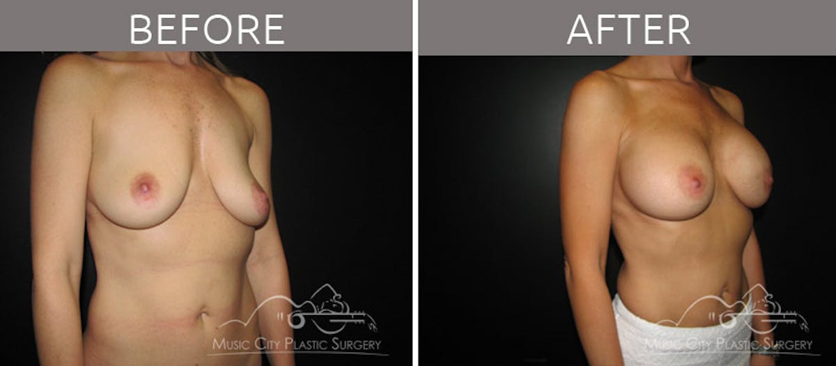 Breast Augmentation Before & After Gallery - Patient 90705149 - Image 6