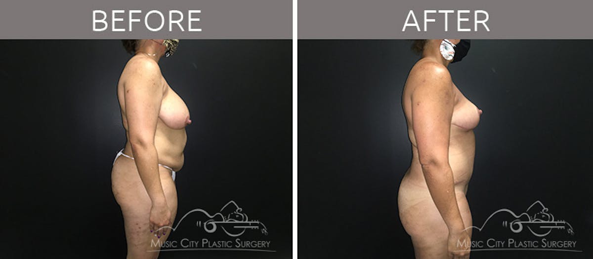 Breast Reduction with Lift Before & After Gallery - Patient 132099792 - Image 5