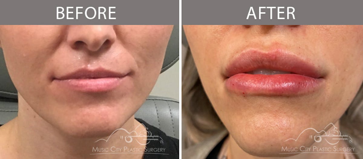 Dermal Fillers Before & After Gallery - Patient 90705151 - Image 1
