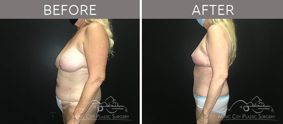 Mommy Makeover Before & After Gallery - Patient 90709142 - Image 3