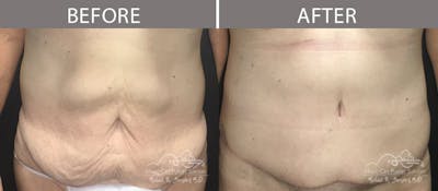 Abdominoplasty Before & After Gallery - Patient 90705158 - Image 1