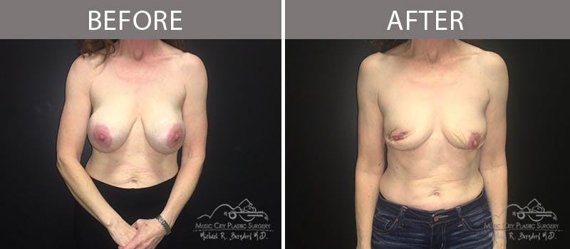 Capsulectomy Before & After Gallery - Patient 90705157 - Image 3