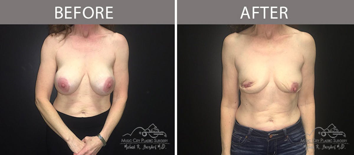 Capsulectomy Before & After Gallery - Patient 90705157 - Image 1