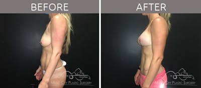 Breast Lift with Augmentation Before & After Gallery - Patient 132099626 - Image 3