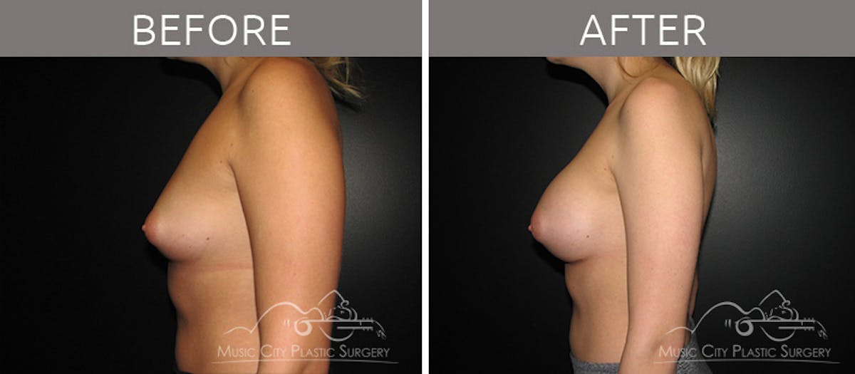 Breast Lift Before & After Gallery - Patient 161426511 - Image 3