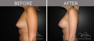 Breast Lift Before & After Gallery - Patient 161426511 - Image 3