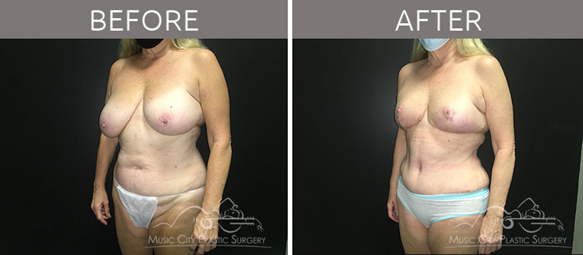 Mommy Makeover Before & After Gallery - Patient 90709142 - Image 2