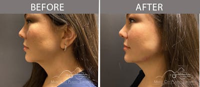 Dermal Fillers Before & After Gallery - Patient 90705161 - Image 1