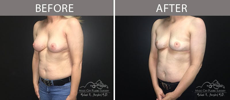 Capsulectomy Before & After Gallery - Patient 90709140 - Image 1