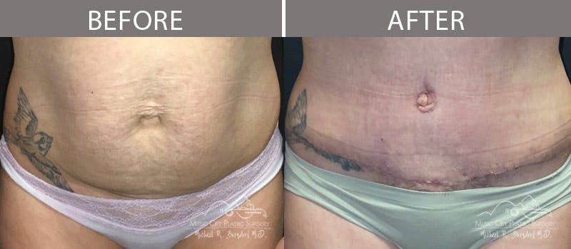 Abdominoplasty Before & After Gallery - Patient 90705163 - Image 1