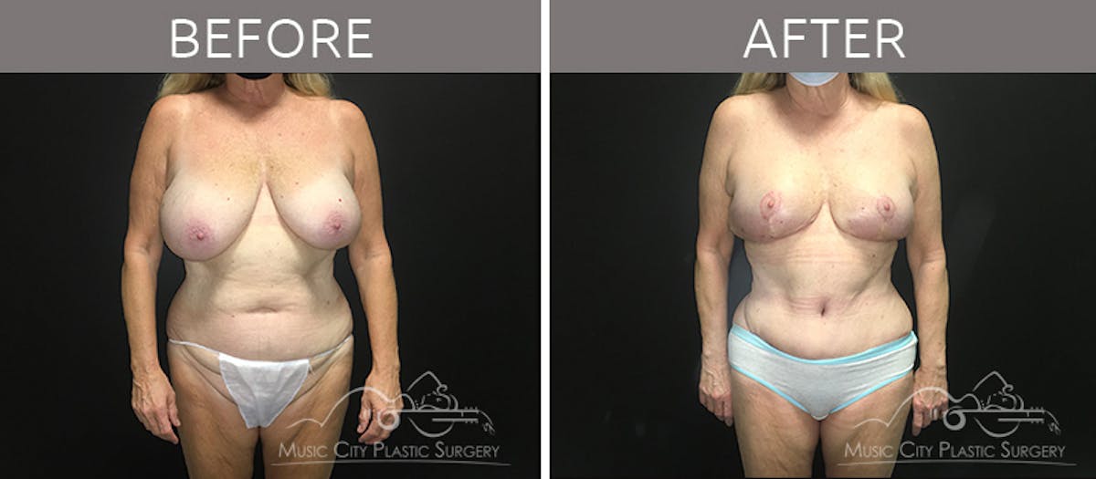 Mommy Makeover Before & After Gallery - Patient 90709142 - Image 1