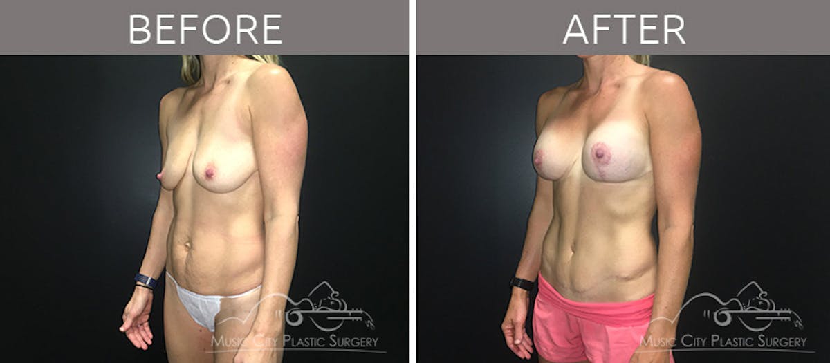 Breast Lift with Augmentation Before & After Gallery - Patient 132099626 - Image 2