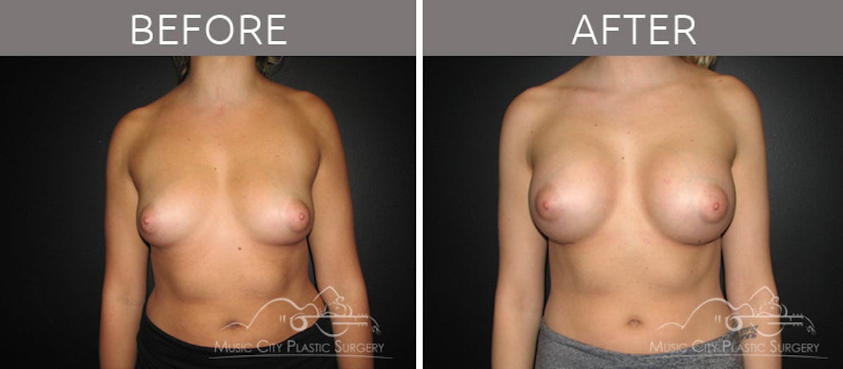 Breast Lift Before & After Gallery - Patient 161426511 - Image 1