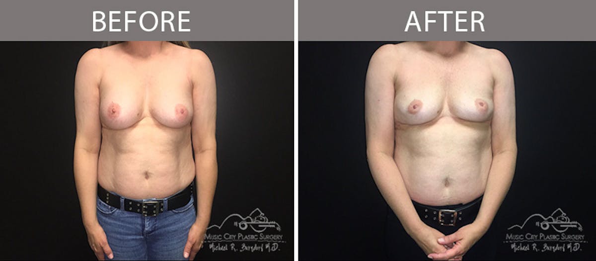 Capsulectomy Before & After Gallery - Patient 90709140 - Image 1