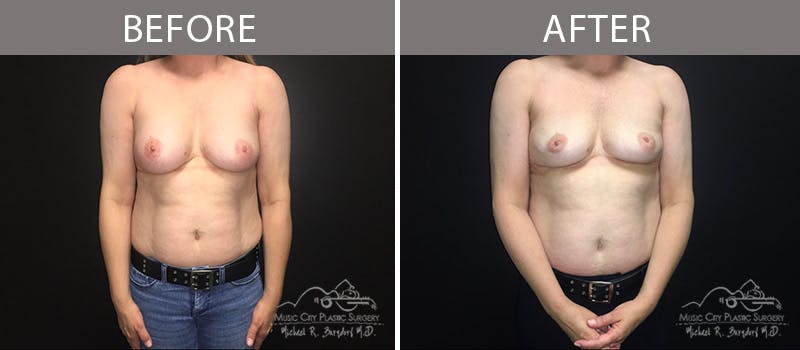 Capsulectomy Before & After Gallery - Patient 90709140 - Image 2