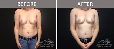 Capsulectomy Before & After Gallery - Patient 90709140 - Image 1