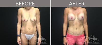 Breast Lift with Augmentation Before & After Gallery - Patient 132099626 - Image 1