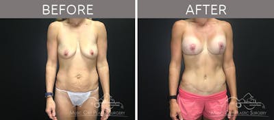Breast Lift with Augmentation Before & After Gallery - Patient 132099626 - Image 3