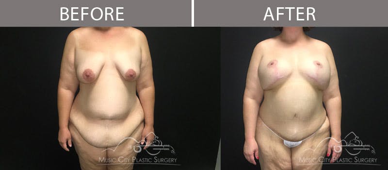 Abdominoplasty Before & After Gallery - Patient 90709143 - Image 1