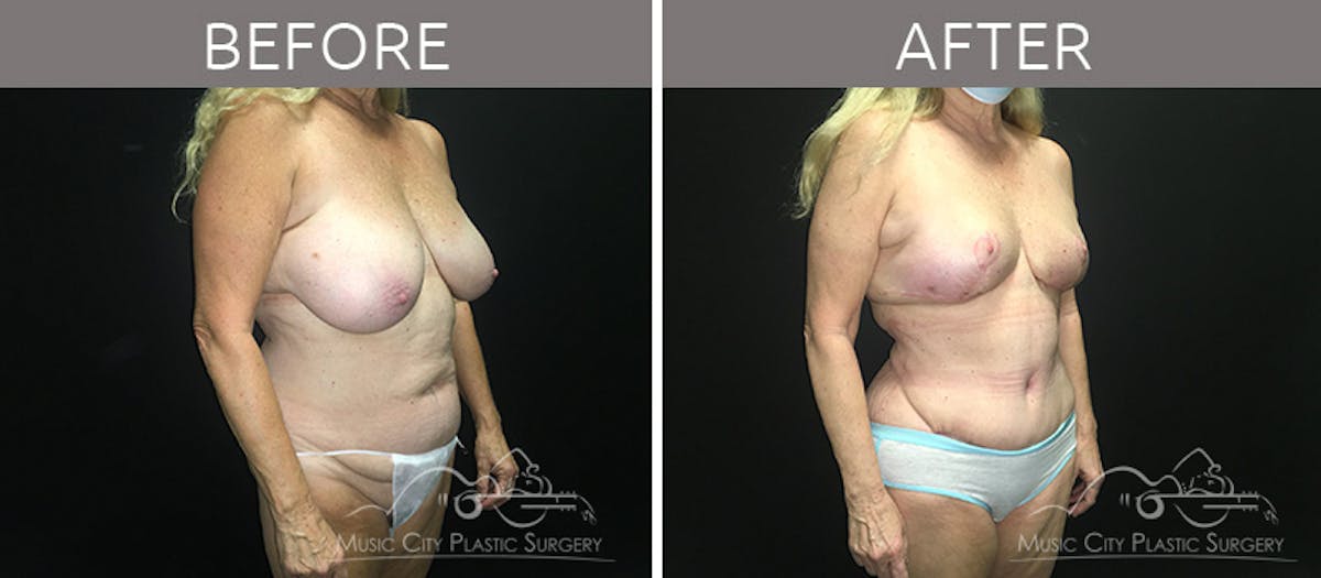 Mommy Makeover Before & After Gallery - Patient 90709142 - Image 4