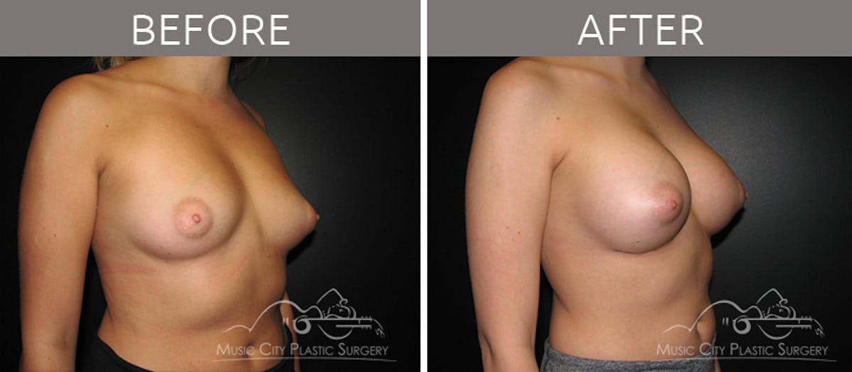 Breast Lift Before & After Gallery - Patient 161426511 - Image 2