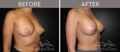 Breast Lift Before & After Gallery - Patient 161426511 - Image 2