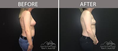 Capsulectomy Before & After Gallery - Patient 90709140 - Image 3