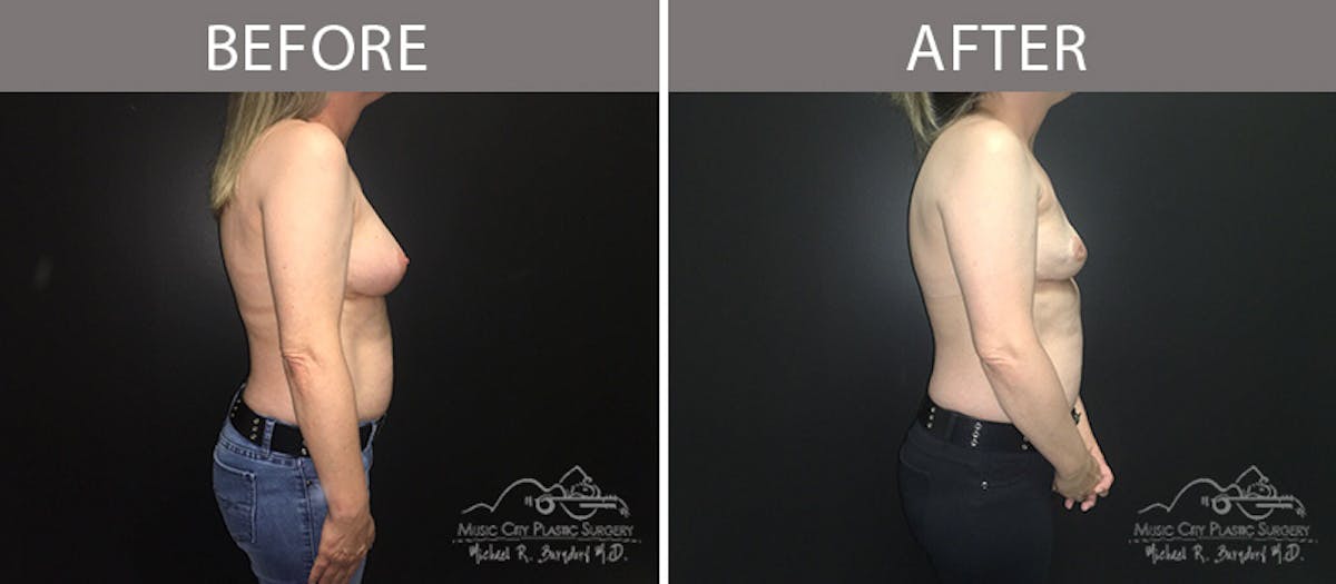Capsulectomy Before & After Gallery - Patient 90709140 - Image 3